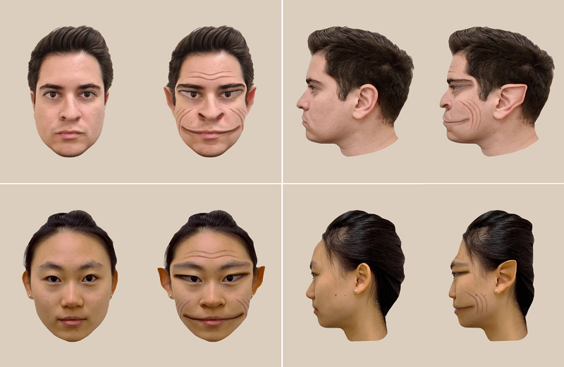 بیماری نادری که چهره افراد را شبیه فیلترهای Tiktok می کند!