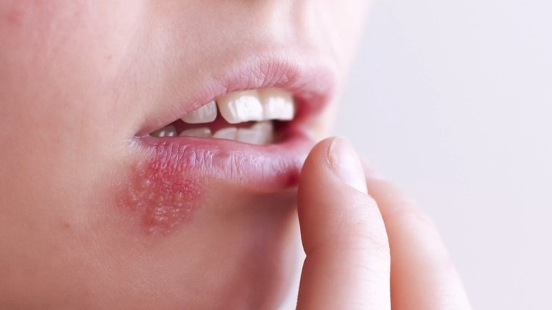 چگونه از شر تبخال خلاص شویم؟