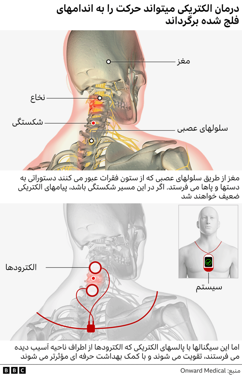 پالس های الکتریکی ممکن است بتوانند فلج را پس از شکستگی گردن بهبود بخشند