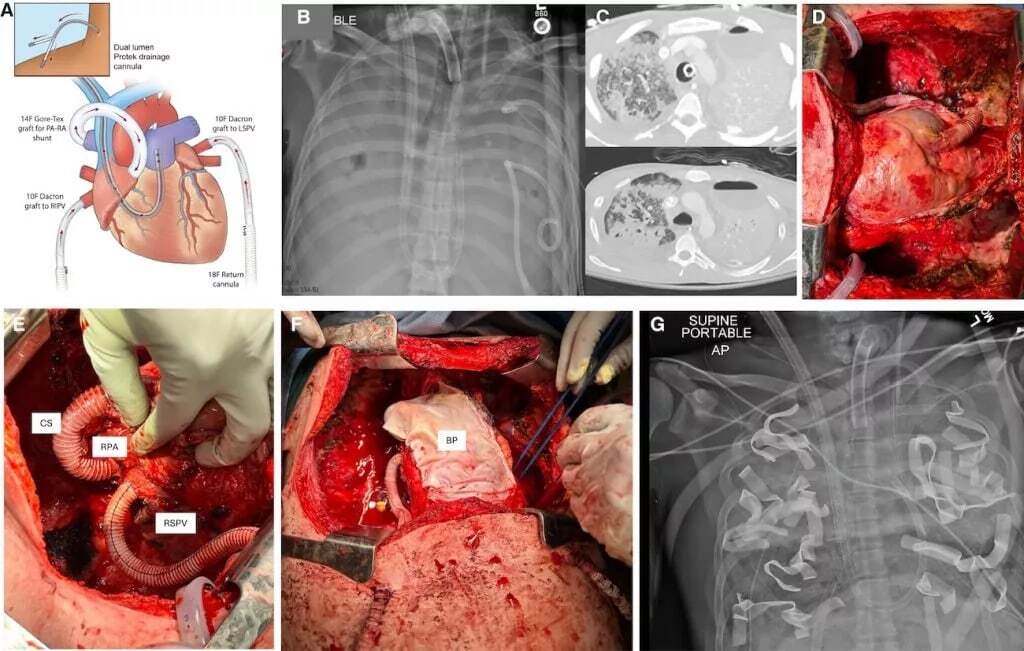 دستاورد پزشکان آمریکایی؛ چگونه یک بیمار 48 ساعت بدون ریه زنده ماند؟ دستاورد پزشکان آمریکایی؛ چگونه یک بیمار 48 ساعت بدون ریه زنده ماند؟